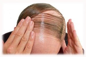 Alopecia - Ảnh minh họa 2