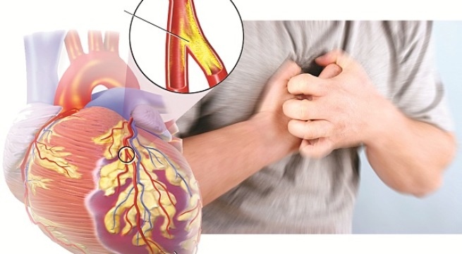 Angina pectoris - Ảnh minh họa 3