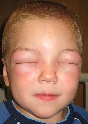 Angioedema - Ảnh minh họa 3