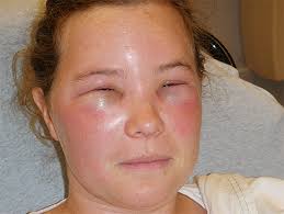 Angioedema - Ảnh minh họa 4