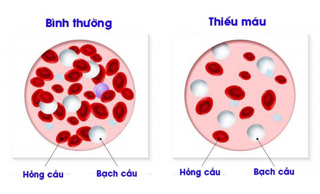 Aplastic anemia - Ảnh minh họa 2