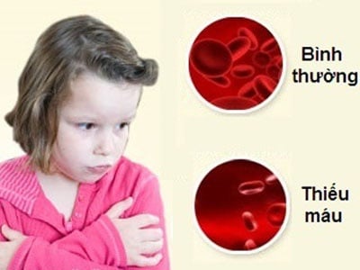 Aplastic anemia - Ảnh minh họa 3