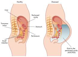 Ascites - Ảnh minh họa 2