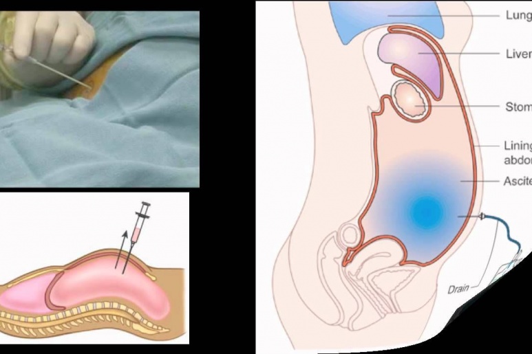 Ascites - Ảnh minh họa 1