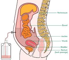 Ascites - Ảnh minh họa 3