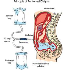 Ascites - Ảnh minh họa 4