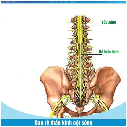 Lý rễ thần kinh cổ - Ảnh minh họa 2