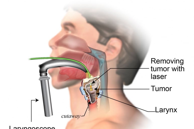 Larynx Cancer - Ảnh minh họa 1