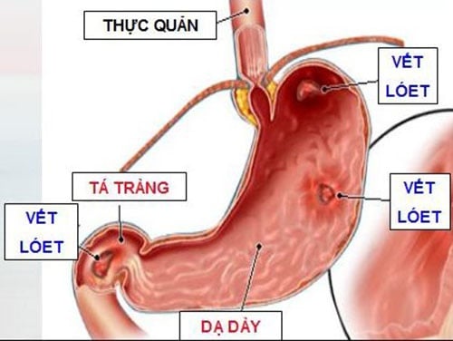 Loét dạ dày - Ảnh minh họa 3