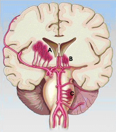 lacunar-infarction - Ảnh minh họa 4