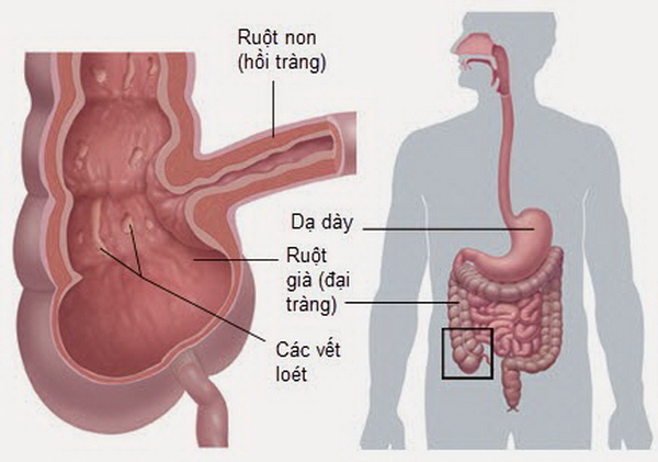 Lao ruột - Ảnh minh họa 2