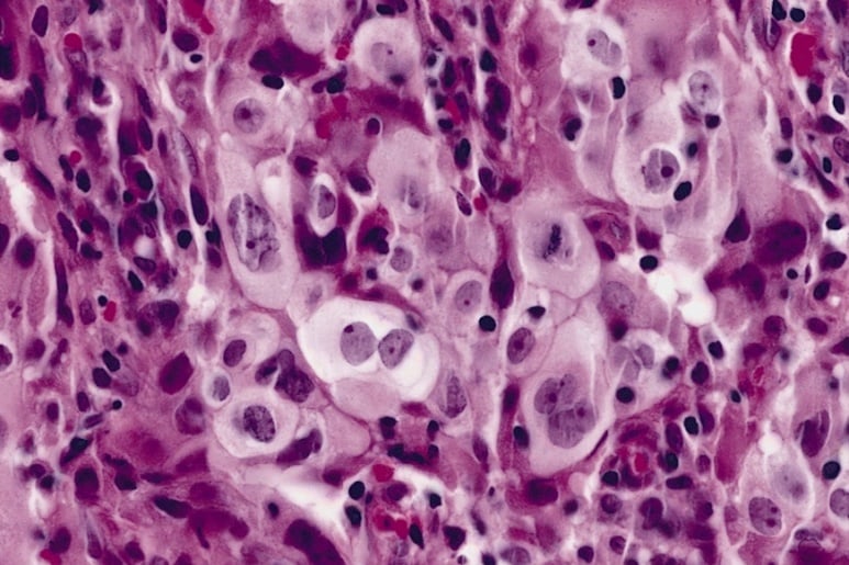 Large cell carcinoma - Ảnh minh họa 2