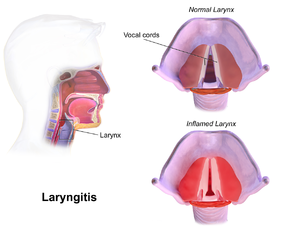 Laryngitis - Ảnh minh họa 2