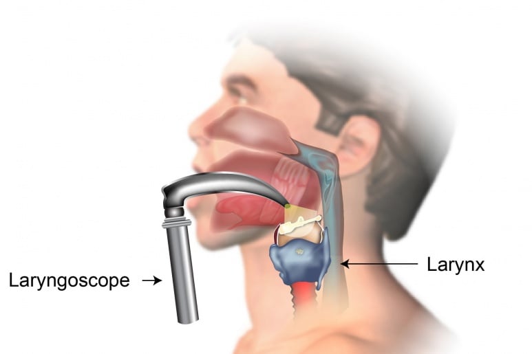 Larynx Cancer - Ảnh minh họa 2