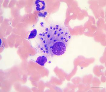 Leishmania niêm mạc và da - Ảnh minh họa 4