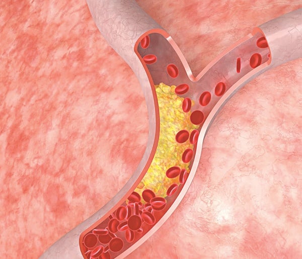 atheroscclerosis - Ảnh minh họa 4