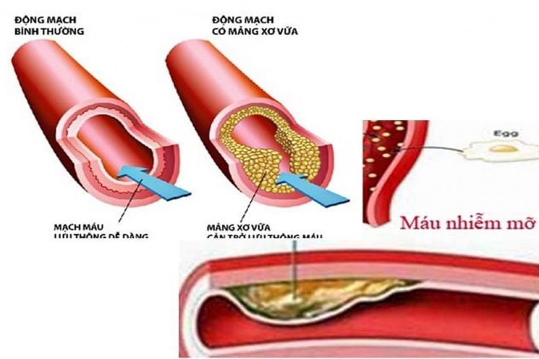 atheroscclerosis - Ảnh minh họa 1