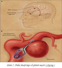 Aneurysm - Ảnh minh họa 2