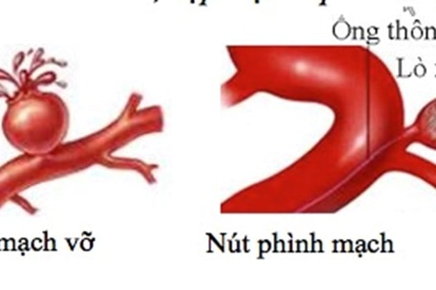 Aneurysm - Ảnh minh họa 3