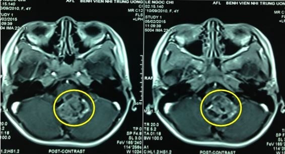 Astrocystoma - Ảnh minh họa 2