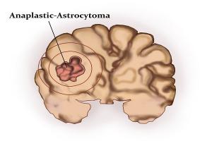 Astrocystoma - Ảnh minh họa 4