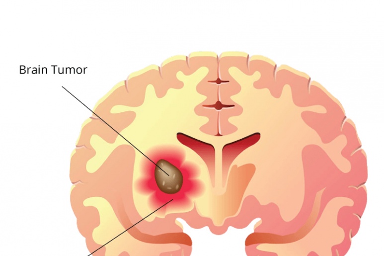 Astrocystoma - Ảnh minh họa 3