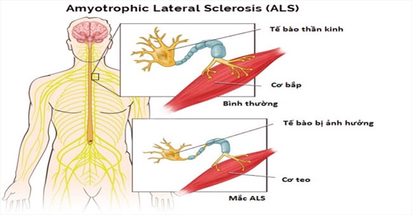 Amyotrophic Lateral Sclerosis - Ảnh minh họa 2