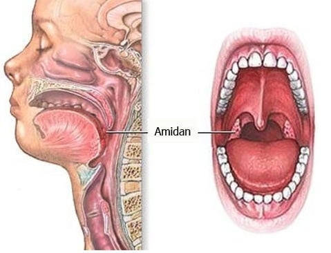 Áp-xe quanh amiđan - Ảnh minh họa 1