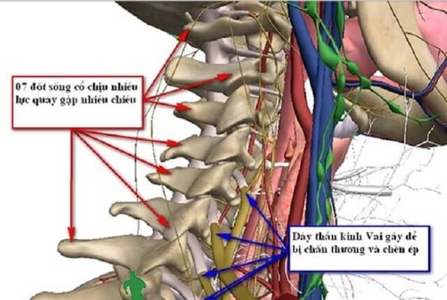 Lý rễ thần kinh cổ - Ảnh minh họa 1