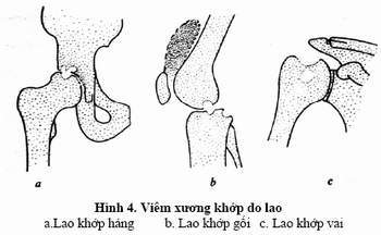 Lao xương - Ảnh minh họa 2