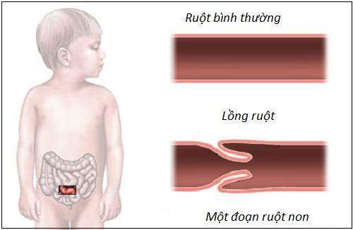 Lồng ruột - Ảnh minh họa 4