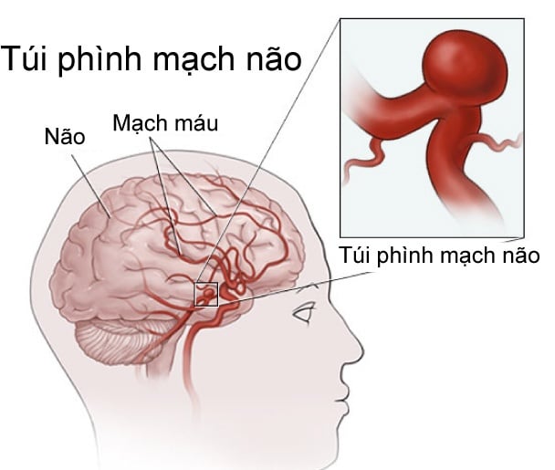 Aneurysm - Ảnh minh họa 1