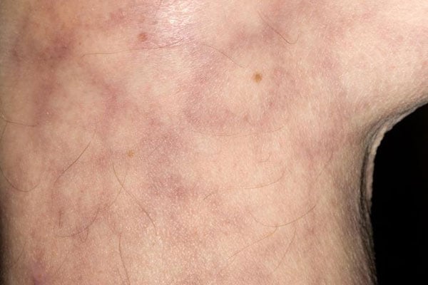 Livedo reticularis - Ảnh minh họa 1