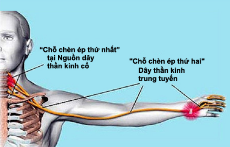 Lý rễ thần kinh cổ - Ảnh minh họa 3