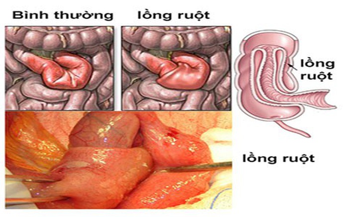 Lồng ruột - Ảnh minh họa 2