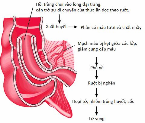 Lồng ruột - Ảnh minh họa 3