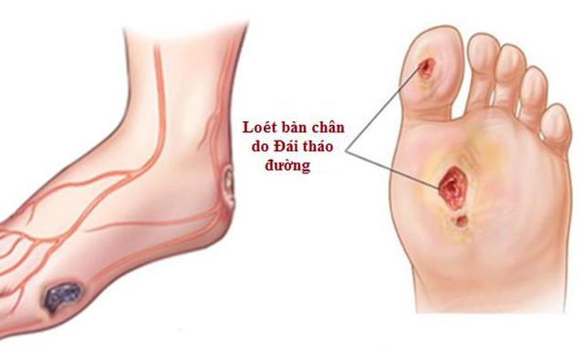 Loét bàn chân - Ảnh minh họa 2