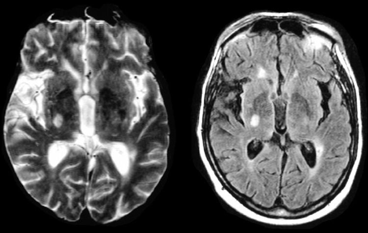 lacunar-infarction - Ảnh minh họa 3