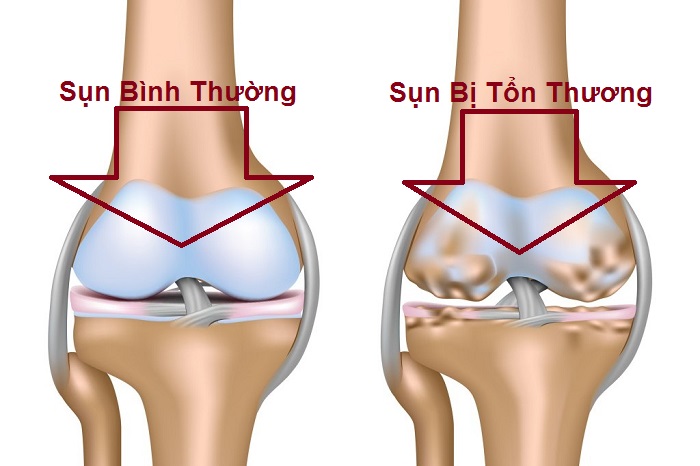 Lao xương - Ảnh minh họa 4