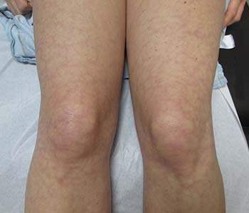 Livedo reticularis - Ảnh minh họa 2