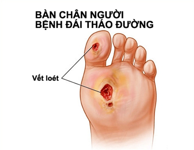 Loét bàn chân - Ảnh minh họa 3