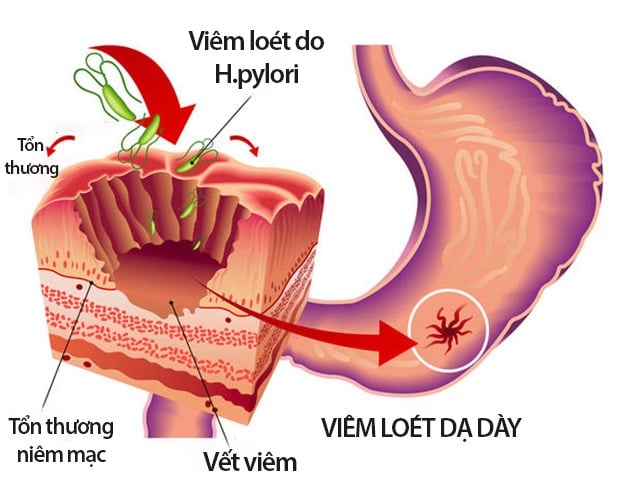 Loét tiêu hóa - Ảnh minh họa 3