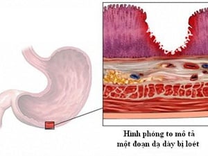 Loét tiêu hóa - Ảnh minh họa 2