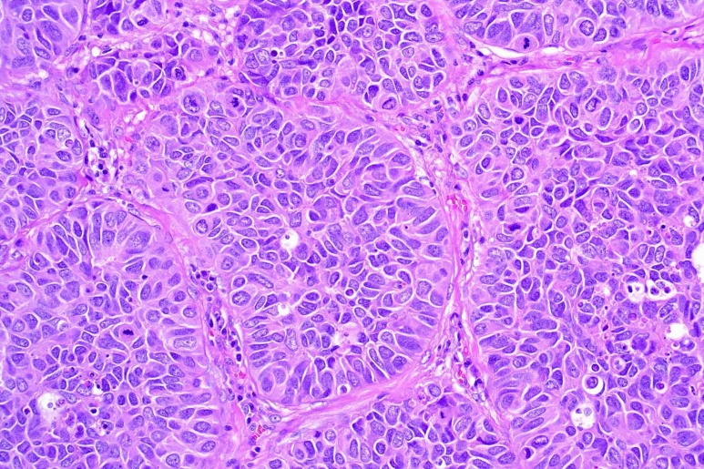 Large cell carcinoma - Ảnh minh họa 3