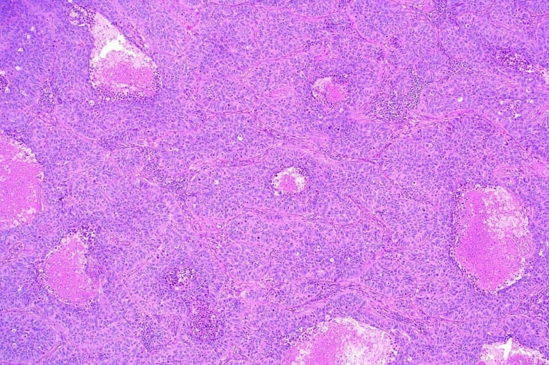 Large cell carcinoma - Ảnh minh họa 4