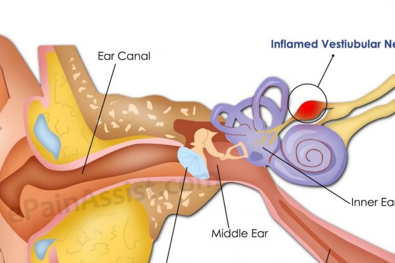 Labyrinthitis - Ảnh minh họa 4