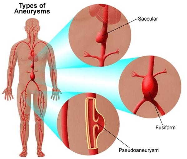 Aneurysm - Ảnh minh họa 4