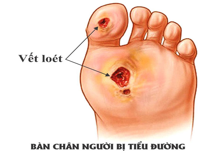 Loét bàn chân - Ảnh minh họa 4