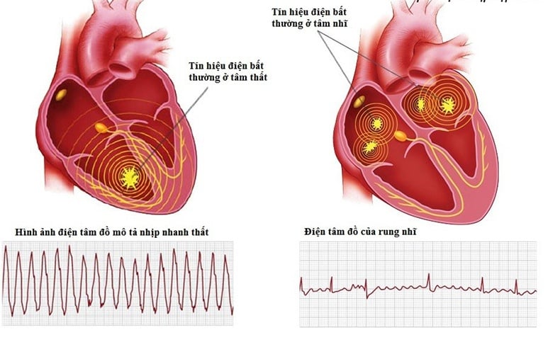 Loạn nhịp tim - Ảnh minh họa 3