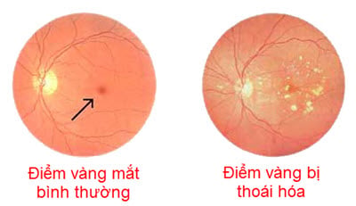 Age-related Macular Degeneration - Ảnh minh họa 4